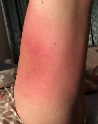 628EA2ED-8C9B-4C6F-B34F-5559E98606AE.jpeg (415.13 KiB) 6776 mal betrachtet Unterseite Oberschenkel